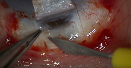 Deep Sclerectomy With Trabeculotomy