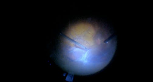 Subsilicone Retinal Detachment