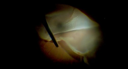 From Chaos to Clarity: Salvaging a Traumatic Macula-Off Retinal Detachment