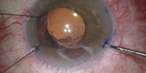 IOL-Sparing Technique in UGH Syndrome