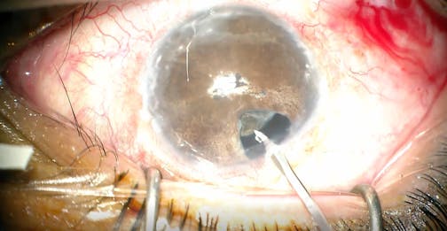 Uveitic Pupilloplasty