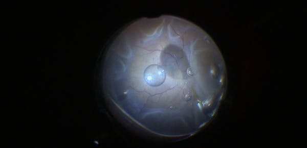 Triple Procedure for Bullous Retinal Detachment thumbnail