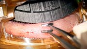 Ziplyft Procedure for Excess Eyelid Skin