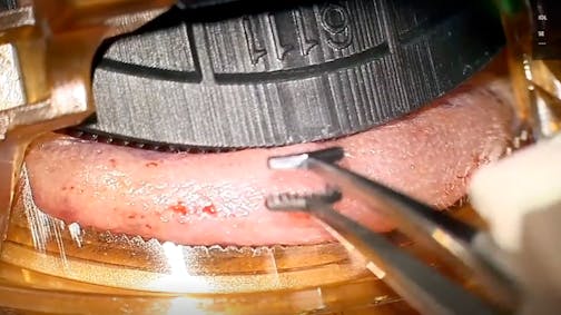 Ziplyft Procedure for Excess Eyelid Skin