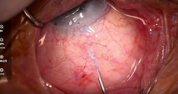 AquaLumen Subconjunctival Bypass Procedure thumbnail