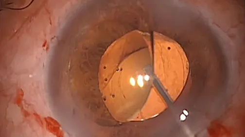 Posterior Capsule Polishing and IOL Explantation With Protective IOL in the Bag