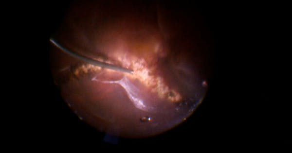 Highly Myopic Retinal Detachment With Crystalline Lens thumbnail