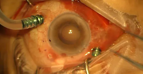 Traumatic White Cataract and Secondary IOL Scleral Fixation