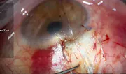 Micro-Scleral Tunnel for PreserFlo