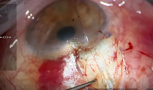 Micro-Scleral Tunnel for PreserFlo