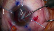 Double Belt Loop Scleral Fixation of a Subluxated IOL and Goniotomy for Pseudoexfoliation Glaucoma