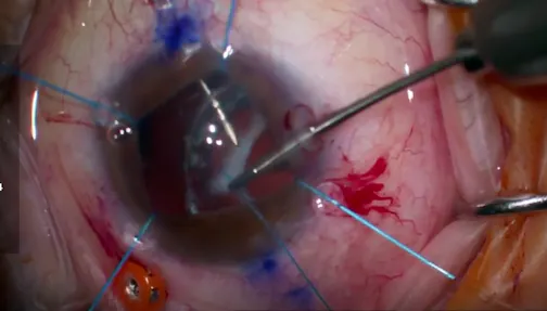 Double Belt Loop Scleral Fixation of a Subluxated IOL and Goniotomy for Pseudoexfoliation Glaucoma