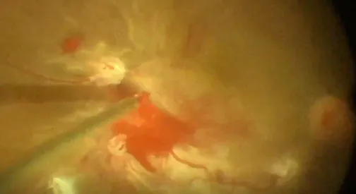Tractional Retinal Detachment Repair: 25G Segmentation and Delaminating