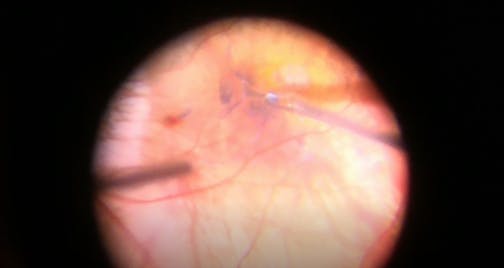 Full-Thickness Macular Hole in a Highly Myopic Eye