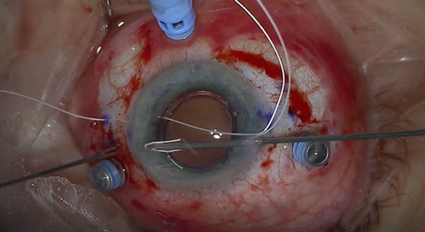Modified Canabrava Technique With Gore-Tex thumbnail