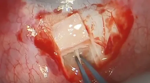 Glaucoma Intrascleral Tube Surgery