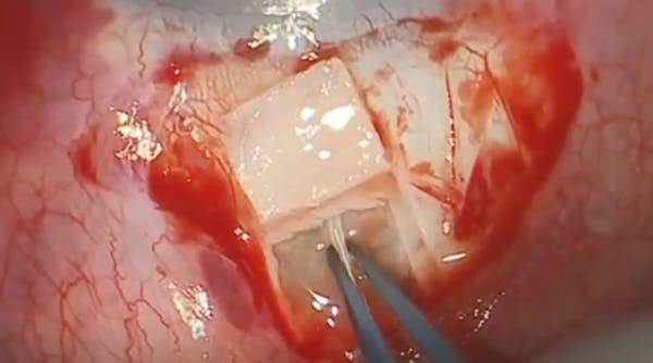 Glaucoma Intrascleral Tube Surgery thumbnail