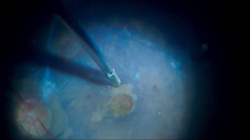 Approaching the Fovea to Peel the ILM in a Near Full-Thickness Macular Defect