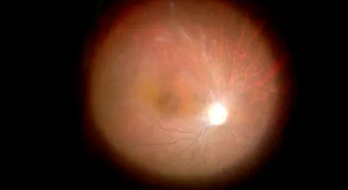 Intraoperative Ocular Ischemia