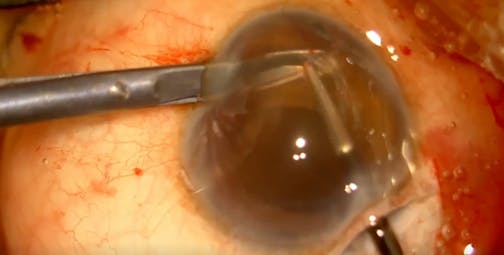 The PMMA Puzzle: Advanced Phaco Technique in a Complex Case
