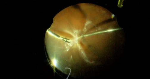 Tractional Retinal Detachment in Monocular Patient