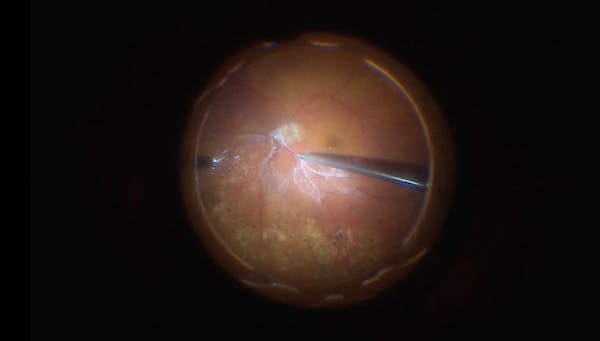 Combined Glaucoma and Retina Surgery thumbnail