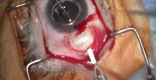 Surgical Implantation of Revakinagene Taroretcel-lwey