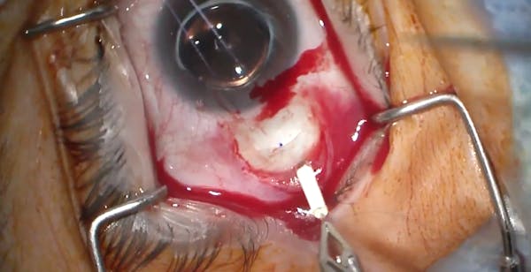 Surgical Implantation of Revakinagene Taroretcel-lwey thumbnail