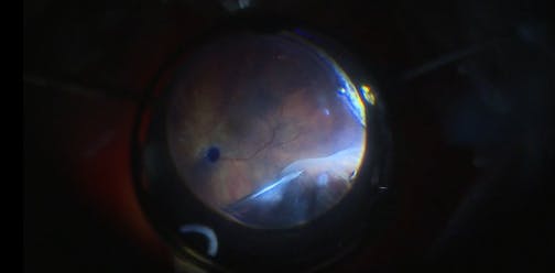 Pseudophakic Retinal Detachment With Posterior PVR