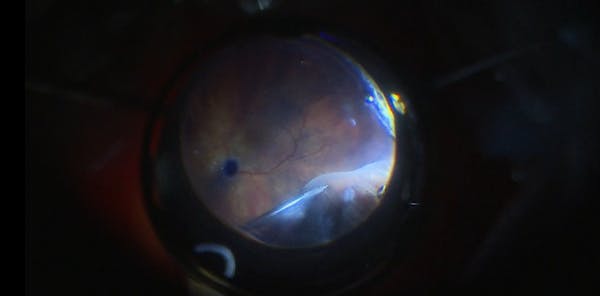 Pseudophakic Retinal Detachment With Posterior PVR thumbnail
