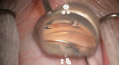 VIA360, 360-Degree Canaloplasty, 90-Degree Goniotomy