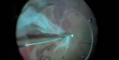 Surgical Management of Combined Tractional and Rhegmatogenous Retinal Detachment and Cataract
