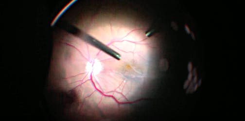 Advanced Surgical Management of Persistent Macular Pucker: Efficacy of the Double Peel Technique