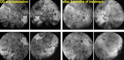Immunosuppressive Therapy for Severe Noninfectious Choroiditis image