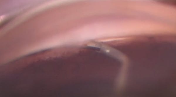 C-Rex Goniotomy thumbnail