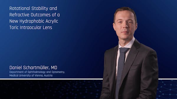 Rotational Stability and Refractive Outcomes of a New Hydrophobic Acrylic Toric Intraocular Lens thumbnail