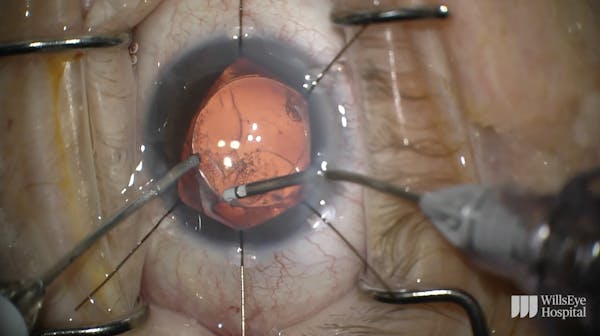 Soemmerring Ring Triggering Uveitis–Glaucoma–Hyphema Syndrome thumbnail