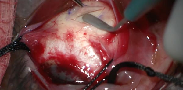 Surgical Management of Exudative Retinal Detachment With Scleral Window thumbnail
