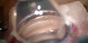 Hydrus Implantation With Gonio Ready