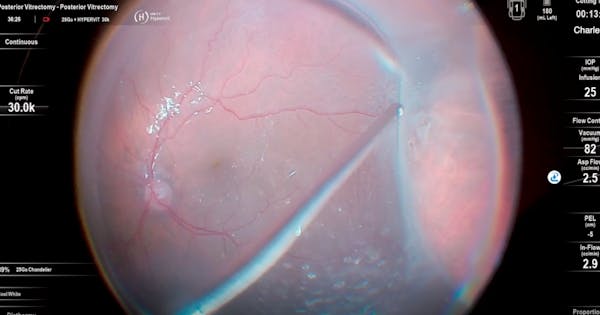Retinal Detachment Repair With the Unity VCS Platform thumbnail