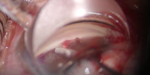 AlloFlo: Supraciliary Device Potpourri