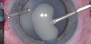 Morgagnian Cataract