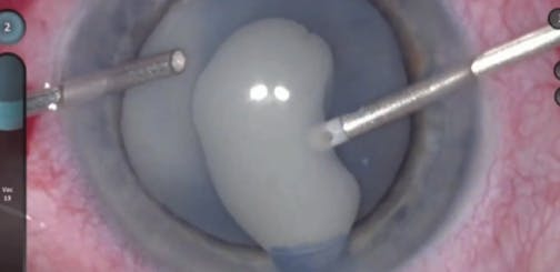 Morgagnian Cataract