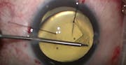 Subluxed Lens