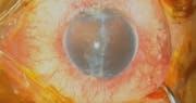 Traumatic Aniridia