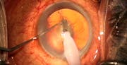 Posterior Polar Cataract