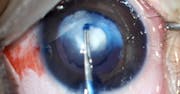 Persistent Hyperplastic Primary Vitreous