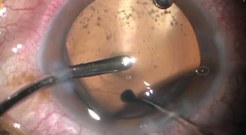 Silicone Removal