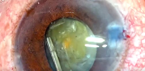 Phacomorphic Angle Closure
