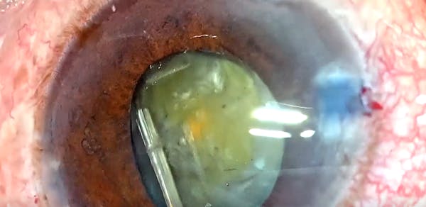 Phacomorphic Angle Closure thumbnail